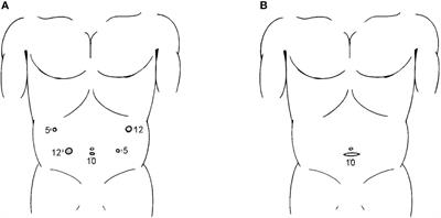 Effectiveness and safety of self-pulling and latter transected Roux-en-Y reconstruction in totally laparoscopic distal gastrectomy